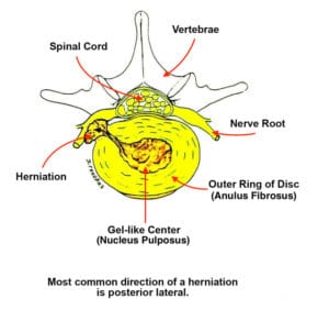 disc herniation treatment in charlotte nc