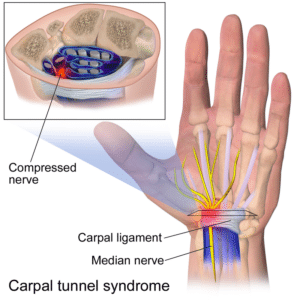 carpal tunnel treatment in charlotte nc