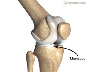 meniscus tear and treatment in charlotte nc