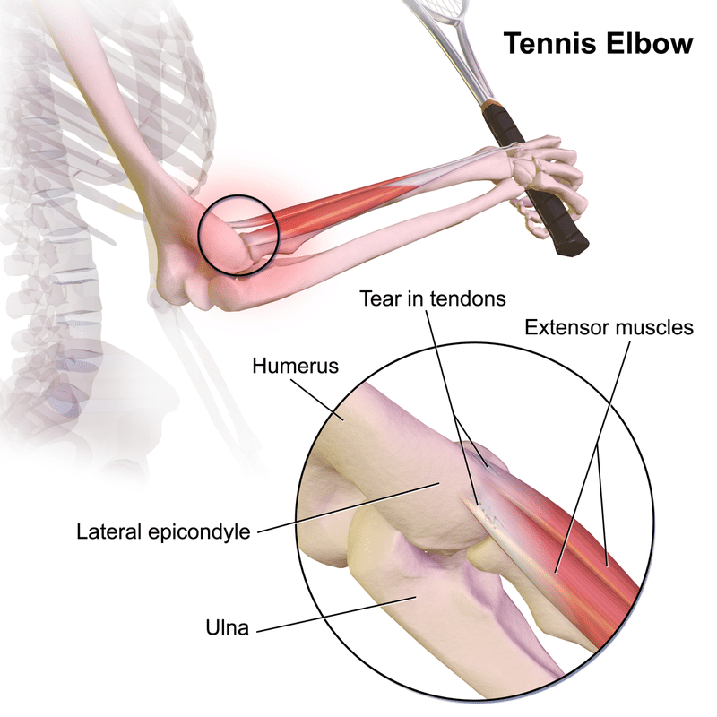 tennis elbow treatment in charlotte nc