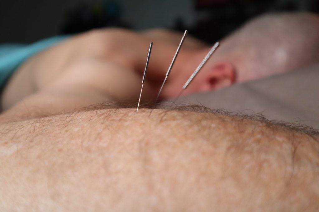 dry needle therapy near me in Charlotte