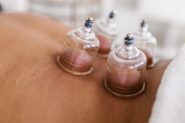 cupping therapy near me in Charlotte
