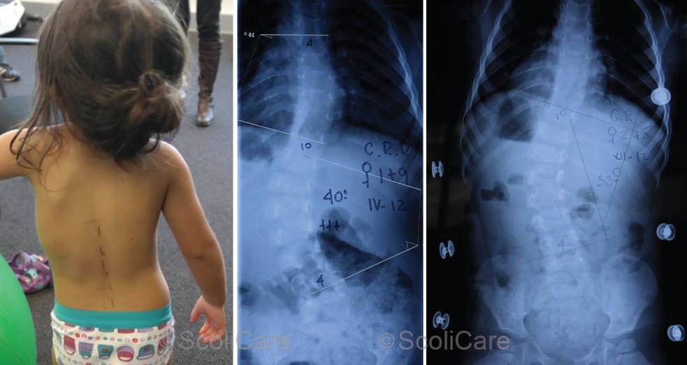 Infantile scoliosis in charlotte nc