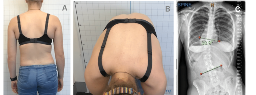 scoliosis examination and measuring charlotte