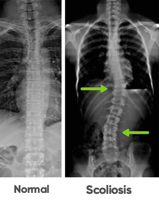 scoliosis on x-ray vs a normal spine in charlotte nc