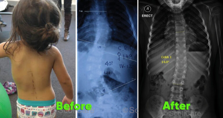 infant experience large reduction in scoliosis curvature