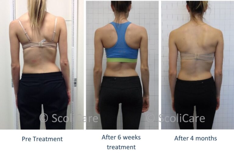 18 year old experiences scoliosis reduction with Scolicare