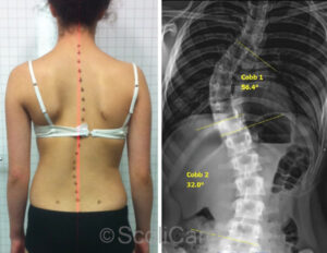 14 year old gymnast experiences reduction in scoliosis