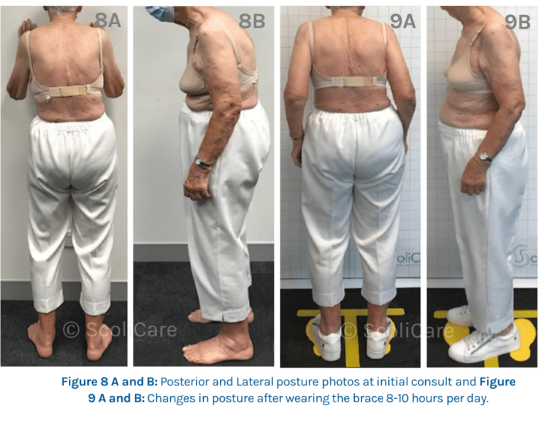 87 year old scoliosis patient demonstrates improvement in pain and posture