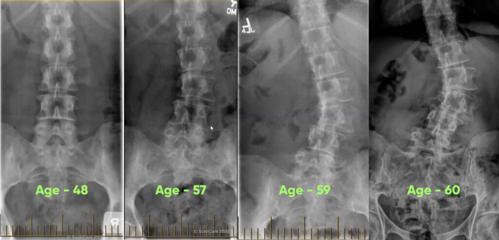 worsening of scoliosis after lack of treatment