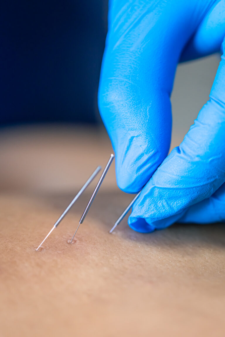 dry needle vs acupuncture in Charlotte nc
