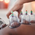 Read more about the article The Effectiveness of Cupping Therapy for Pain Management