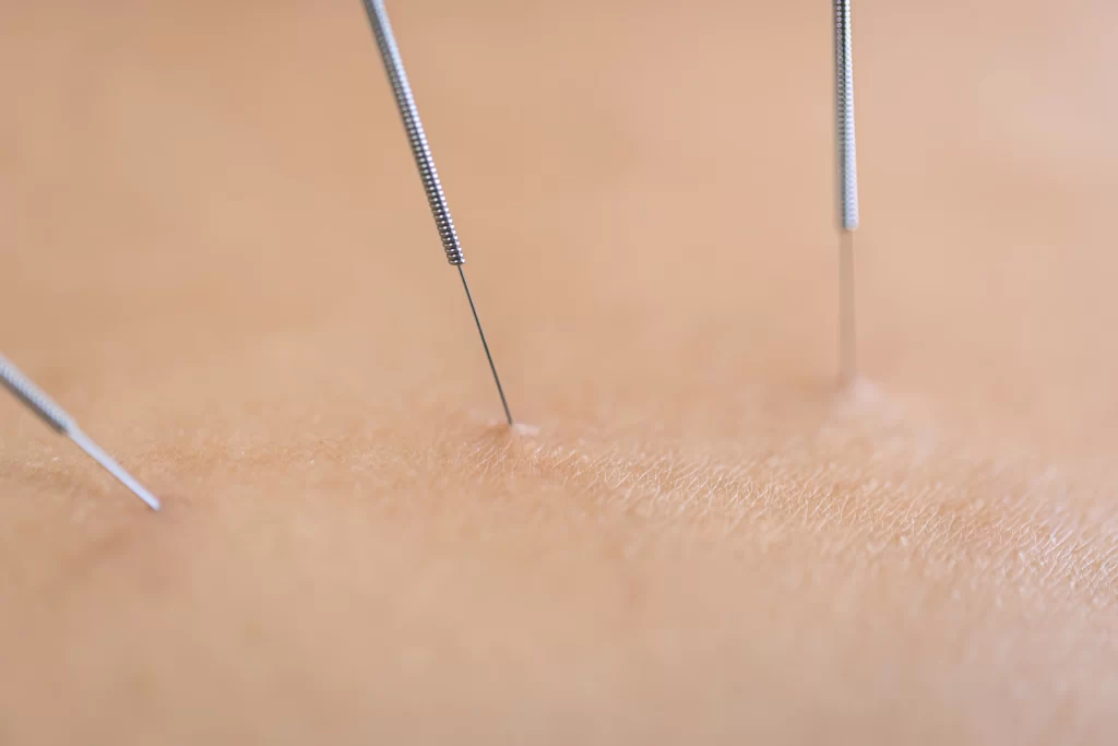 Trigger point injections vs dry needle therapy Charlotte NC