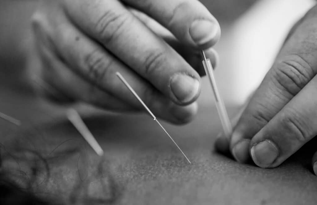 dry needle therapy near me in Charlotte nc