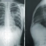 Read more about the article Are X-rays Safe for My Child with Scoliosis? Here’s What the Research Says
