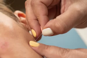dry needle therapy for neck pain relief in Charlotte