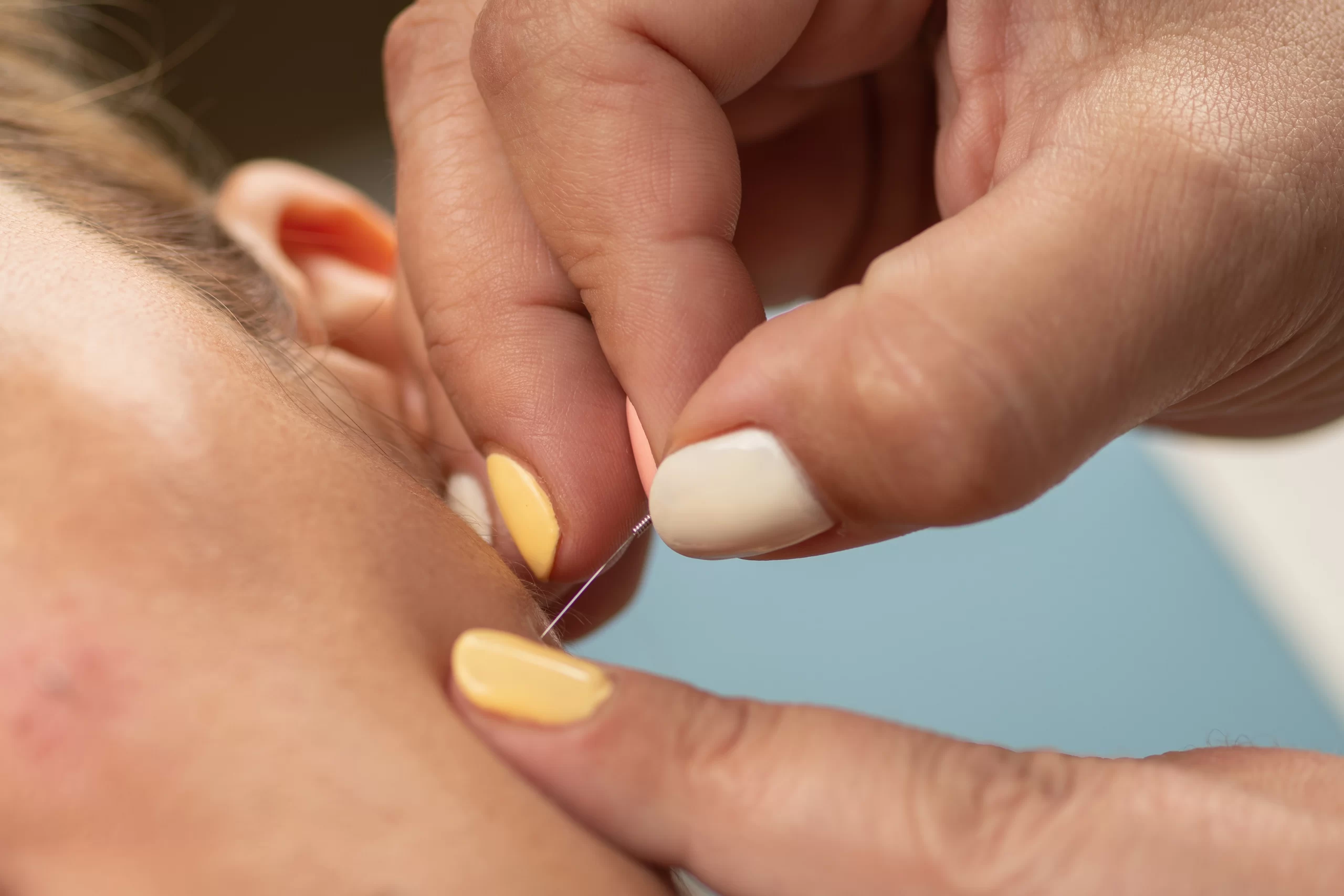 You are currently viewing Dry Needle Therapy for Neck Pain in Charlotte