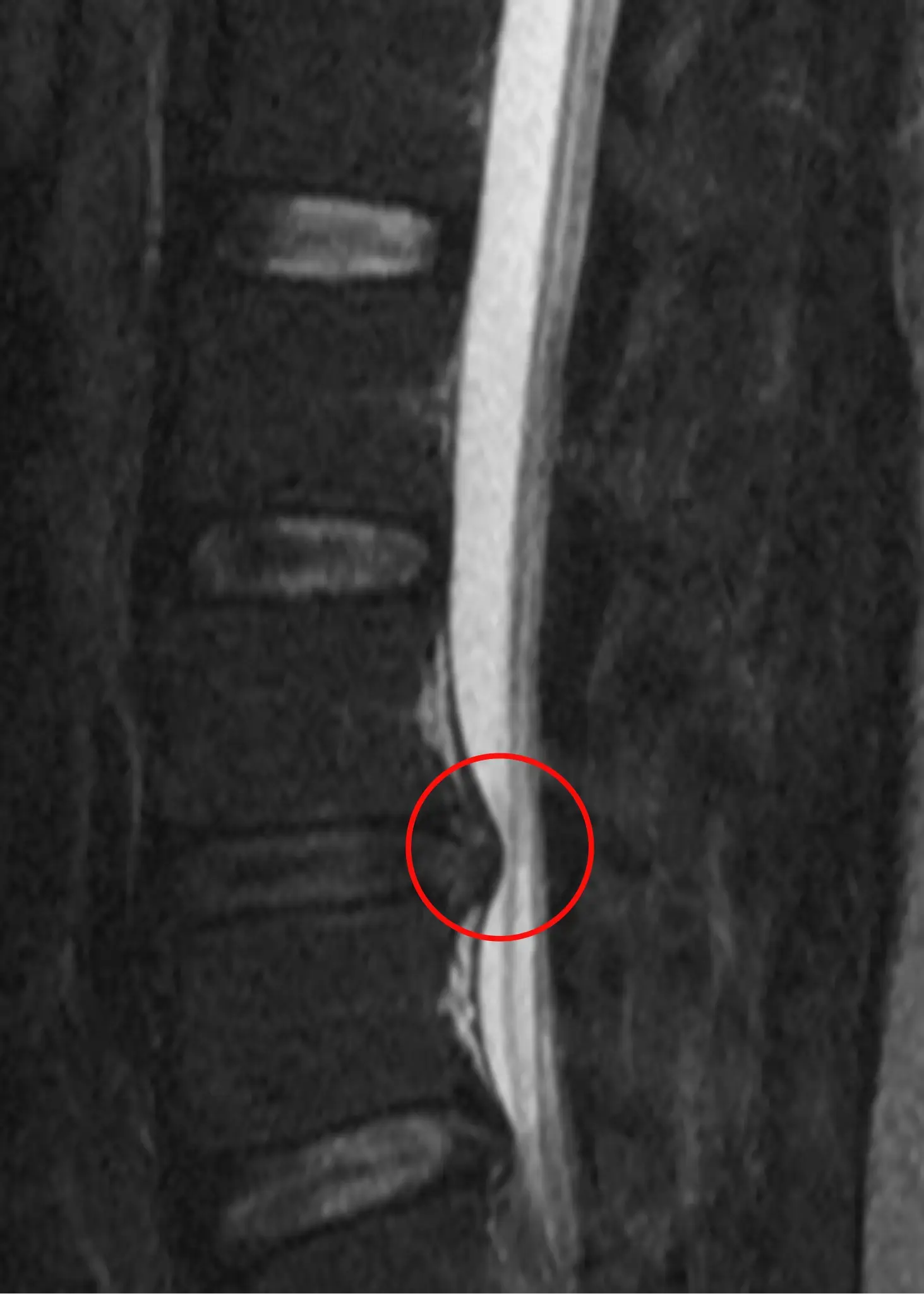 chiropractor for lumbar disc herniation Charlotte nc