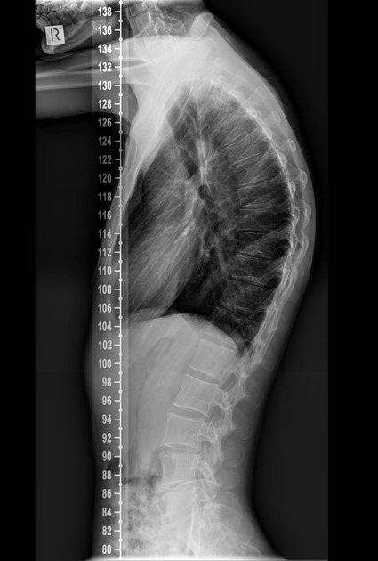 hyperkyphosis treatment in Charlotte nc