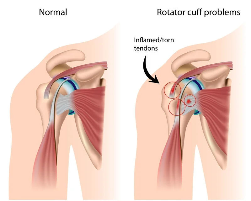 Rotator cuff shoulder injury treatment near me charlotte