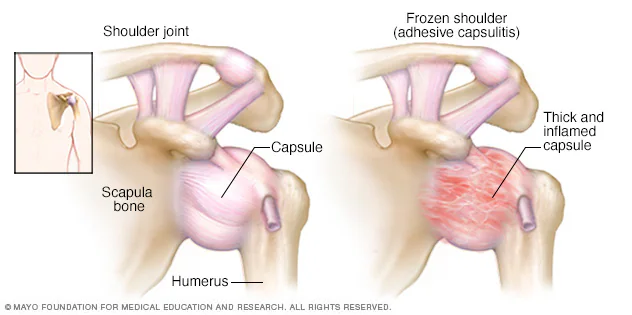 frozen shoulder issues and treatment in Charlotte NC