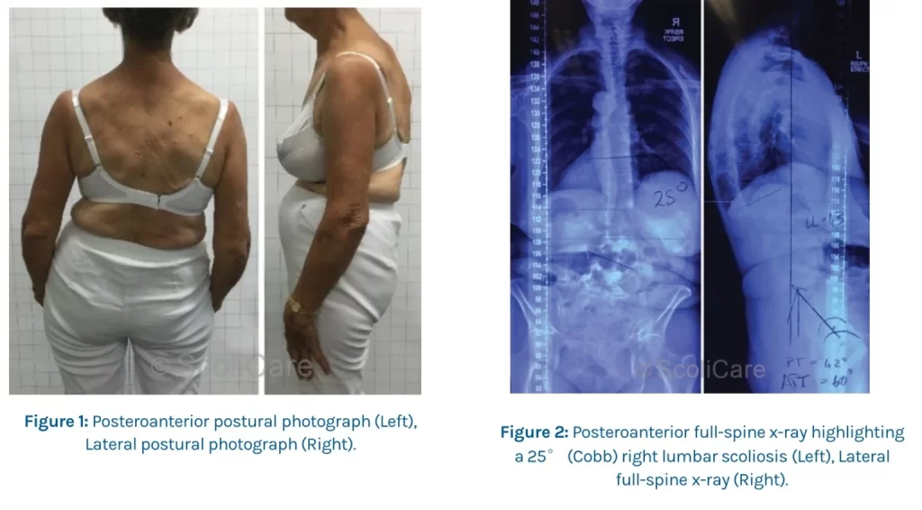 adult scoliosis bracing in Charlotte nc