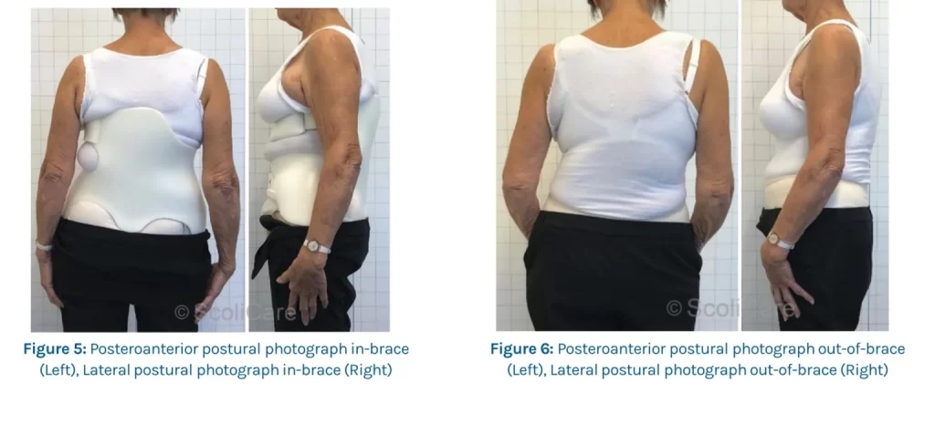 adult and elderly custom bracing for scoliosis in Charlotte nc