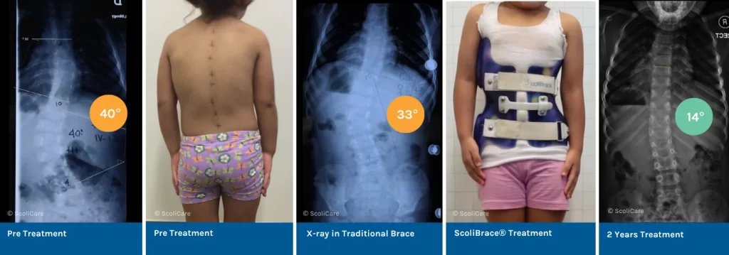 infantile bracing for scoliosis in charlotte