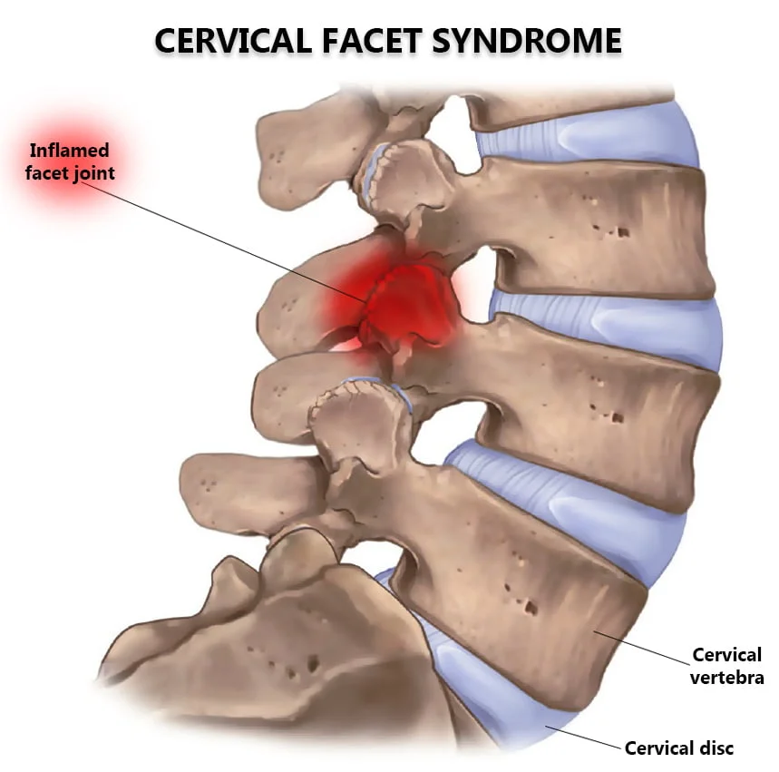 cervical facet syndrome in Charlotte nc