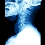 Read more about the article Cervical Facet Syndrome Treatment in Charlotte, NC